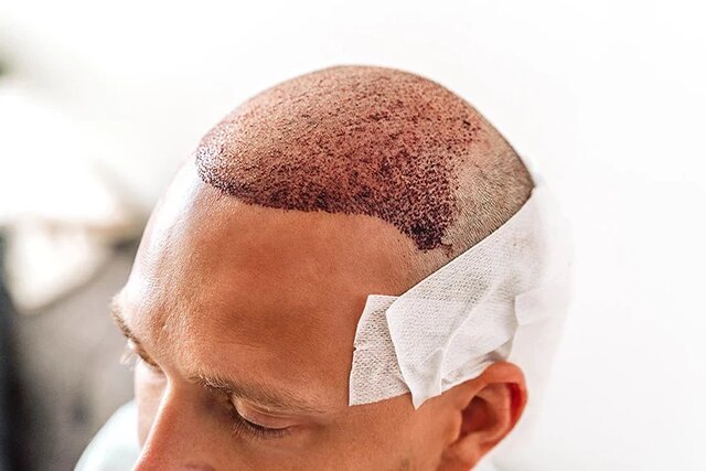 کاشت مو در سال ۲۰۲۵