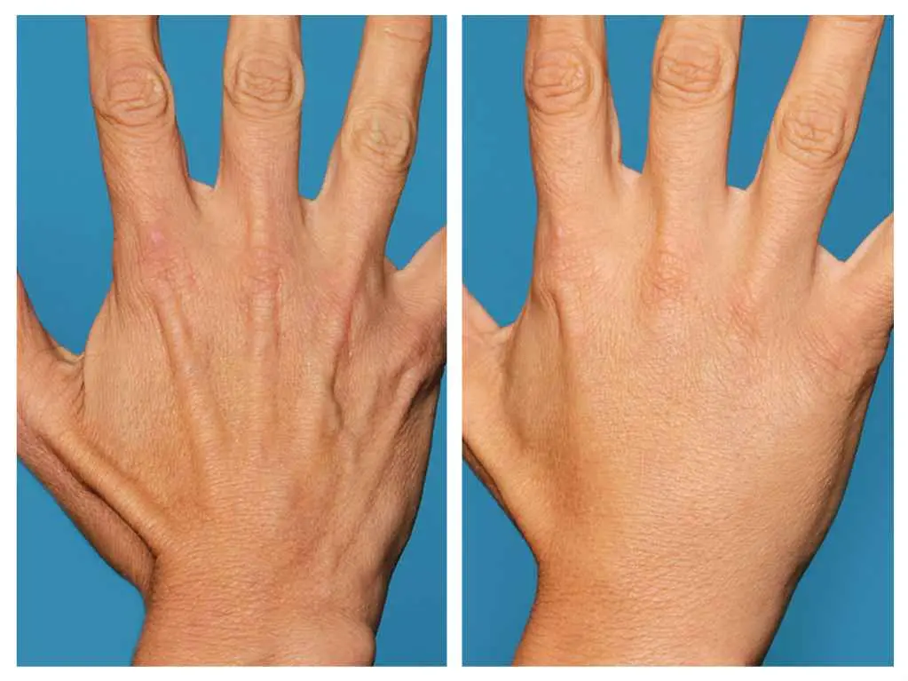 جوانسازی دست‌ها و گردن